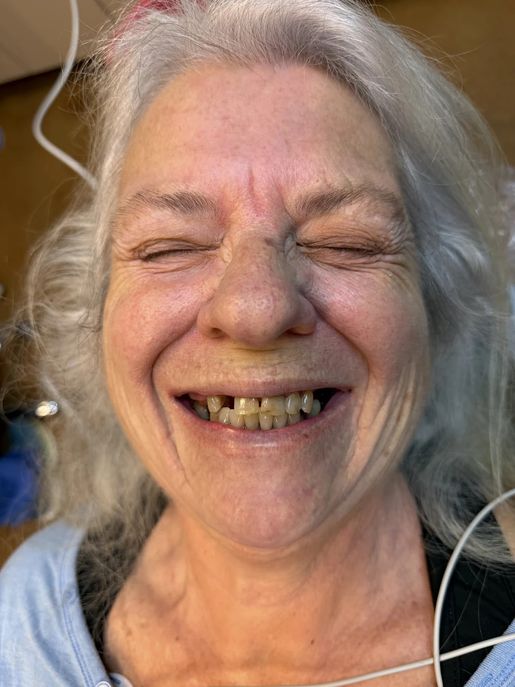Before full-arch dental implant treatment, patient case 01