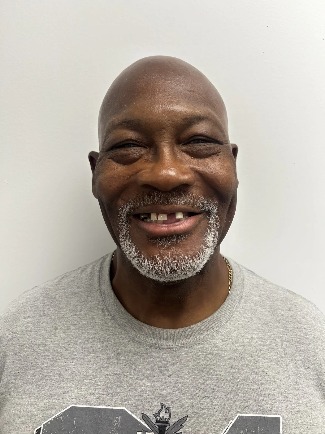 Before full-arch dental implant treatment, patient case 04