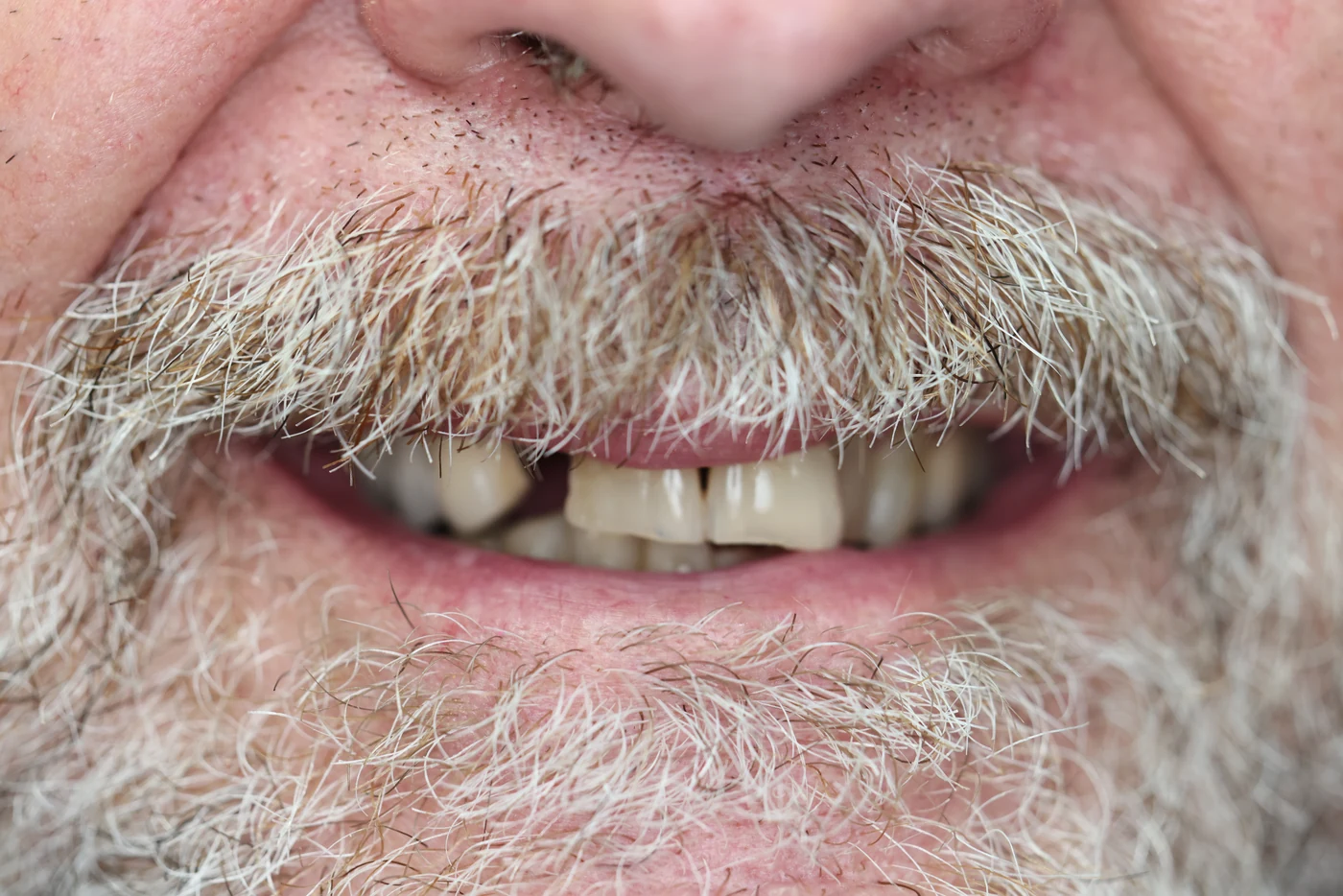 Before single dental implant treatment, patient case 01