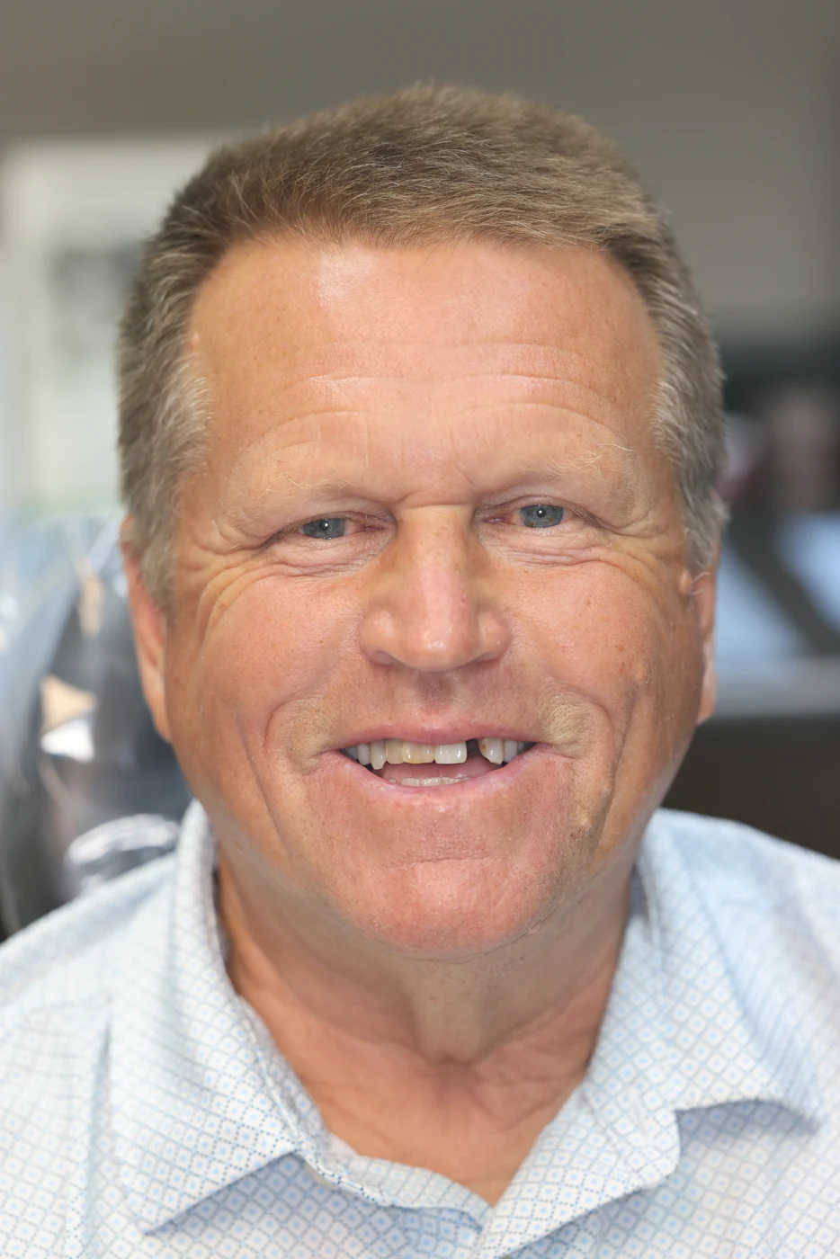 Before single dental implant treatment, patient case 02